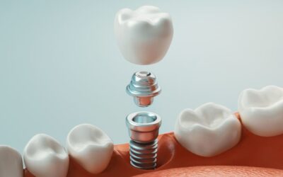 Dental Implants: Your Journey to a Restored Smile